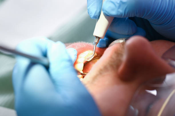 Best Chipped Tooth Repair Near Me  in Notre Dame, IN